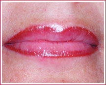 Lippen nachher