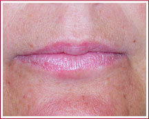Lippen vorher