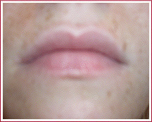 Lippen vorher